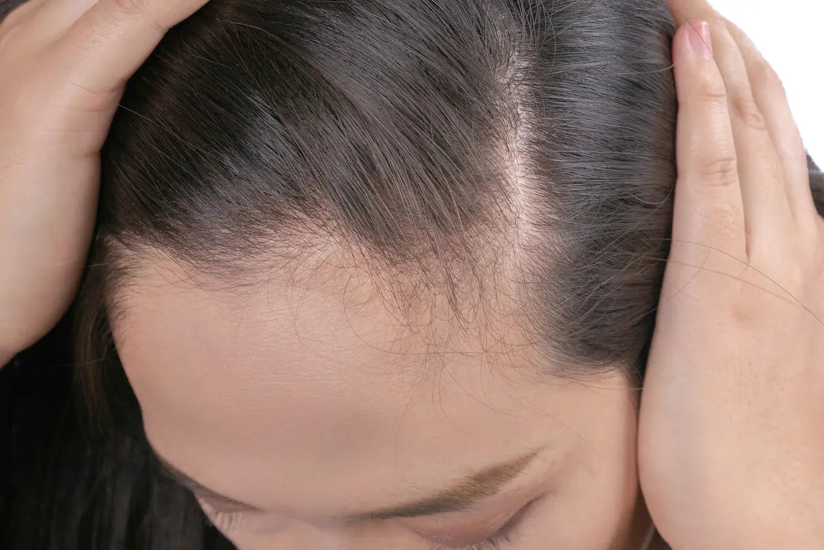 Łysienie plackowate (alopecia areata) - profesjonalny przewodnik trychologa