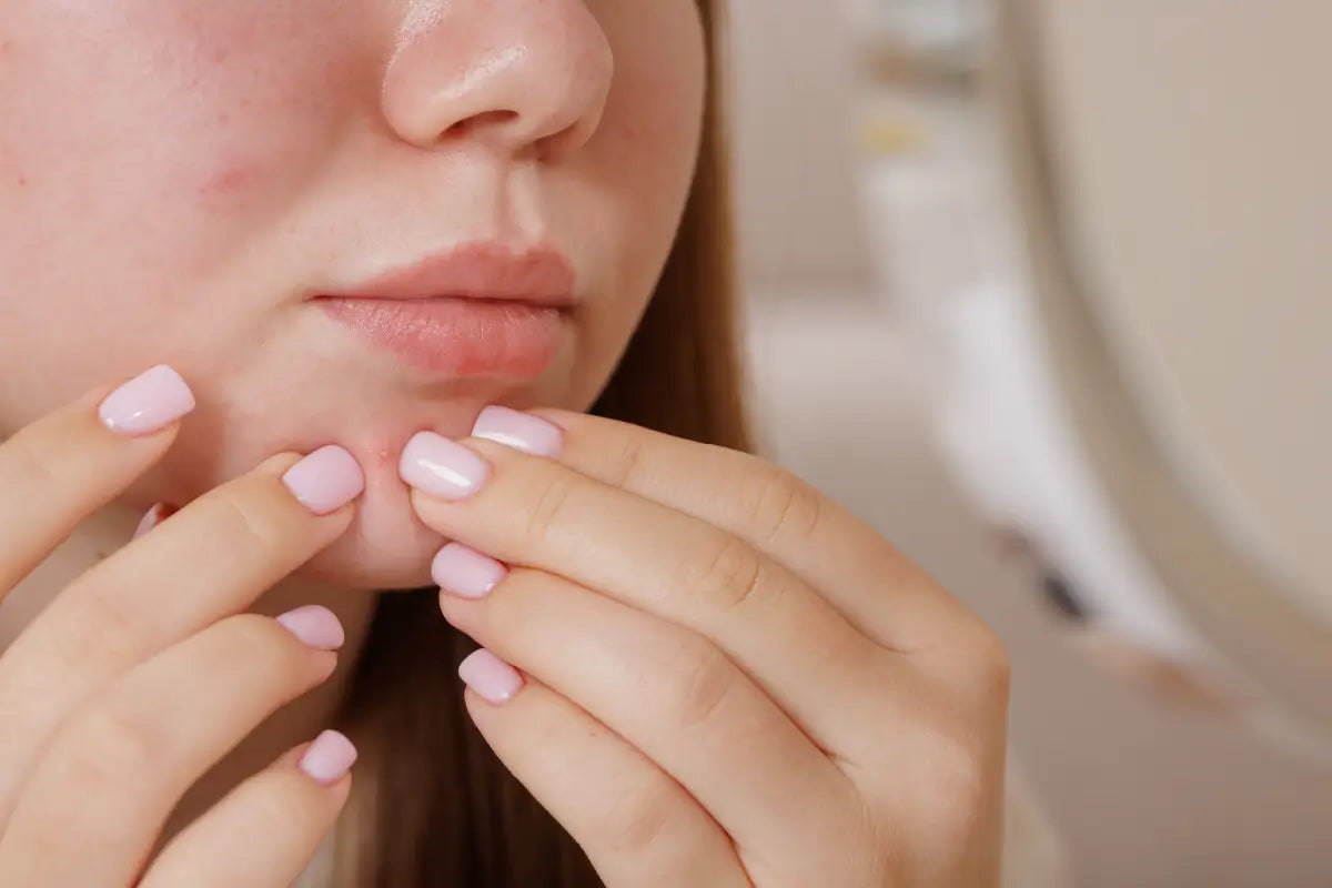 Wypryski na brodzie - przyczyny, skuteczna pielęgnacja i plan działania (poradnik kosmetologa)